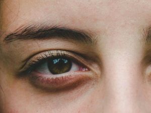 ojeras